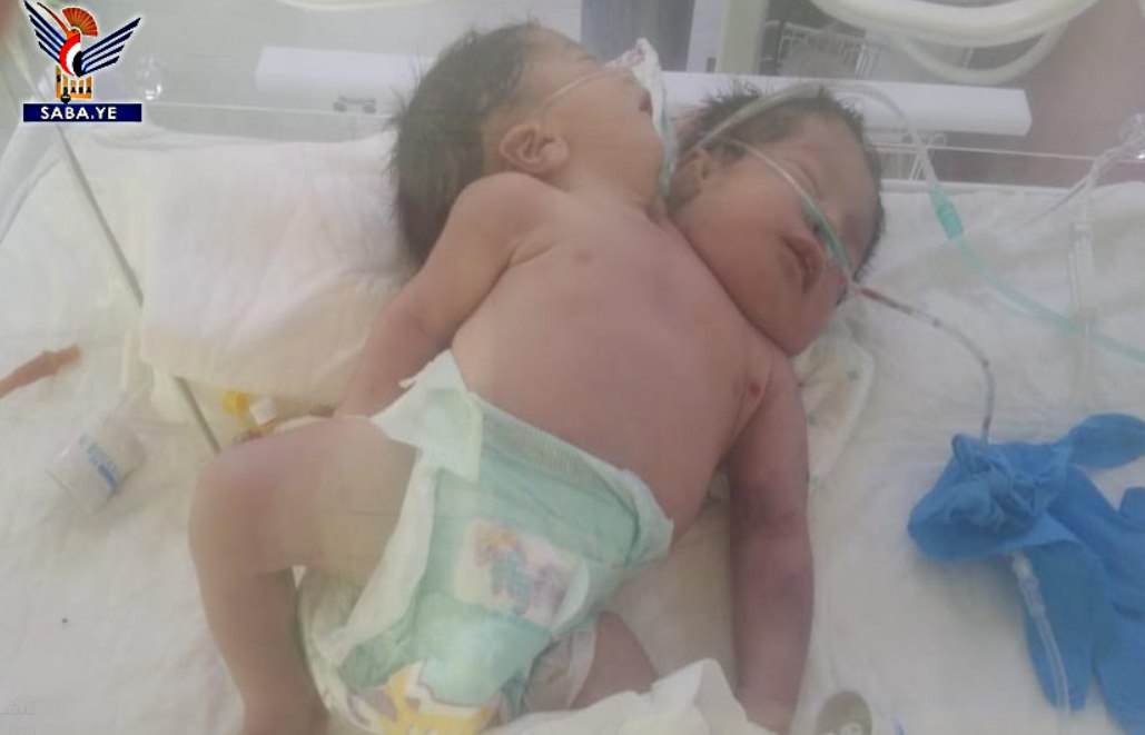 ولادة توأم سيامي في مستشفى فلسطين بأمانة العاصمة